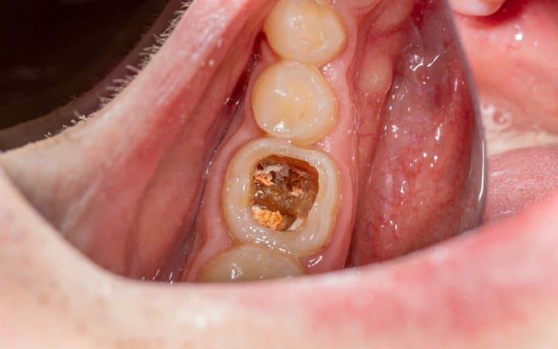 What happens to natural teeth under crowns?