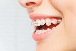 What is the least expensive way to fix teeth?