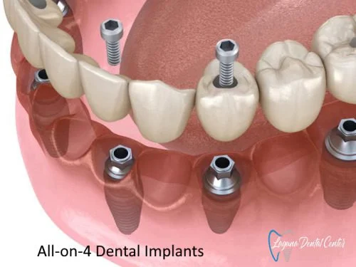 How often do you have to remove All-on-4?