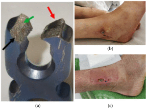 Can your body reject metal implants years later?