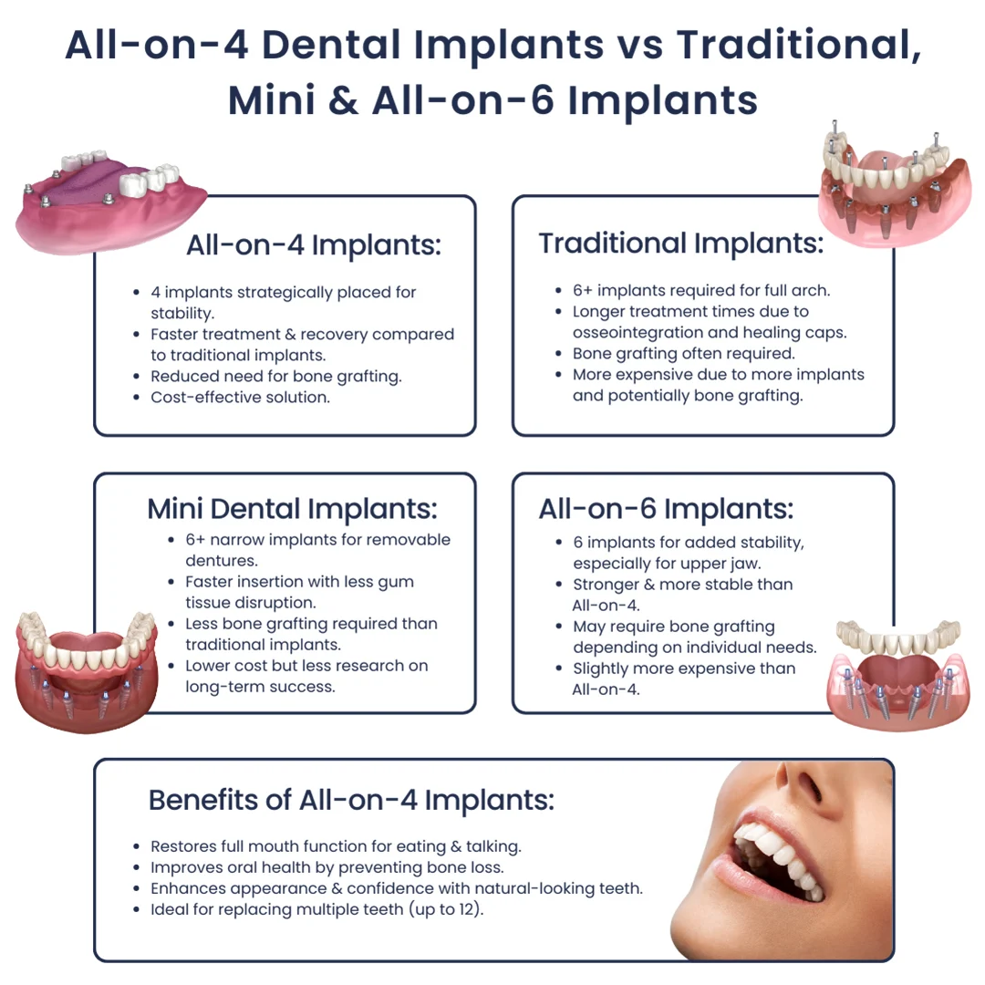 What is the failure rate of All-on-4 dental implants?