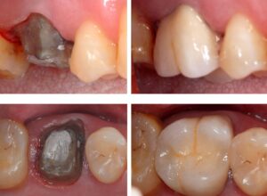 Why does a tooth turn black under a crown?