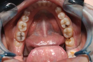 What happens if there is decay under a crown?