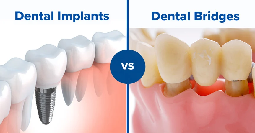 Is a bridge or implant better?