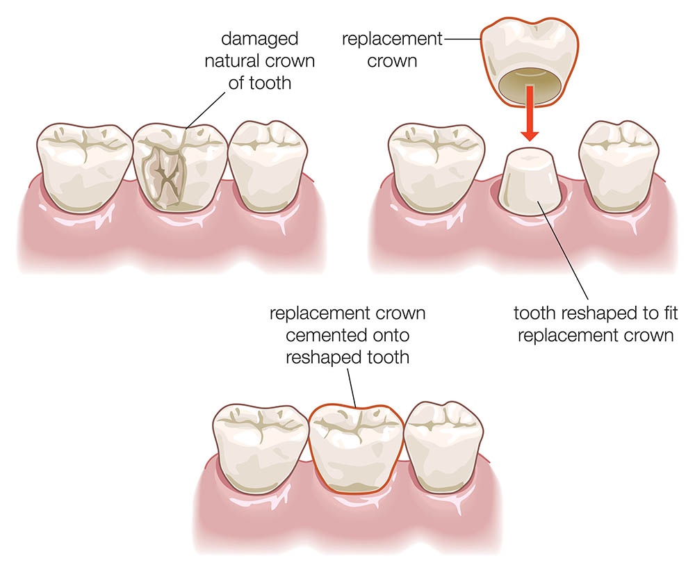 crown tooth