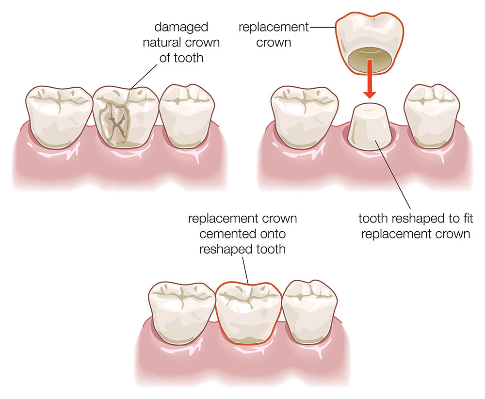 tooth crown