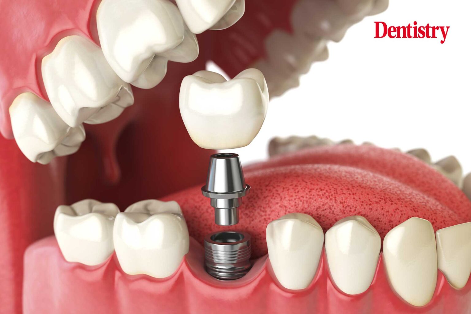 new teeth implants