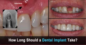 How much does it take to implant a tooth?