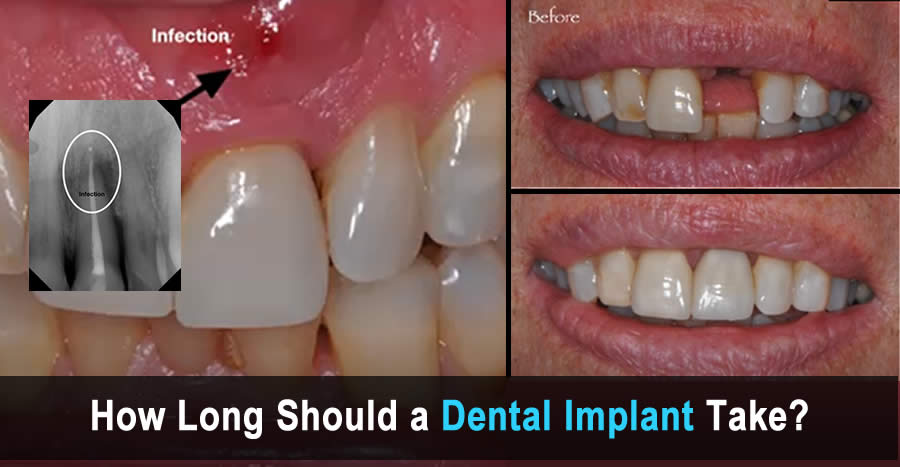 How long does it take to fit one dental implant?