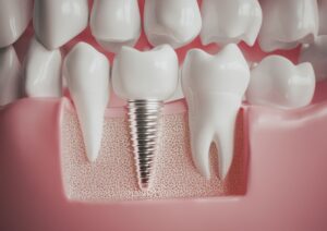Can you get teeth replaced for free?
