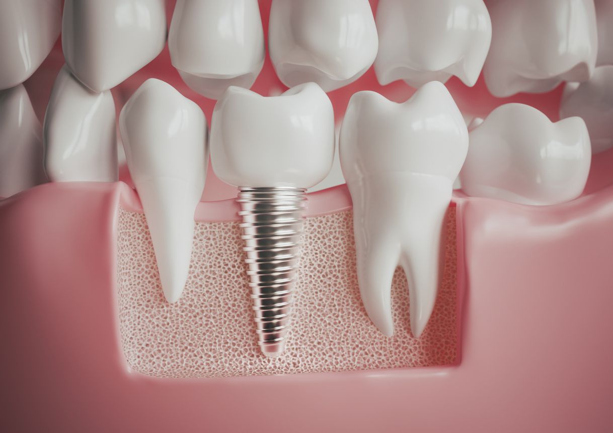 Can you get teeth replaced for free?