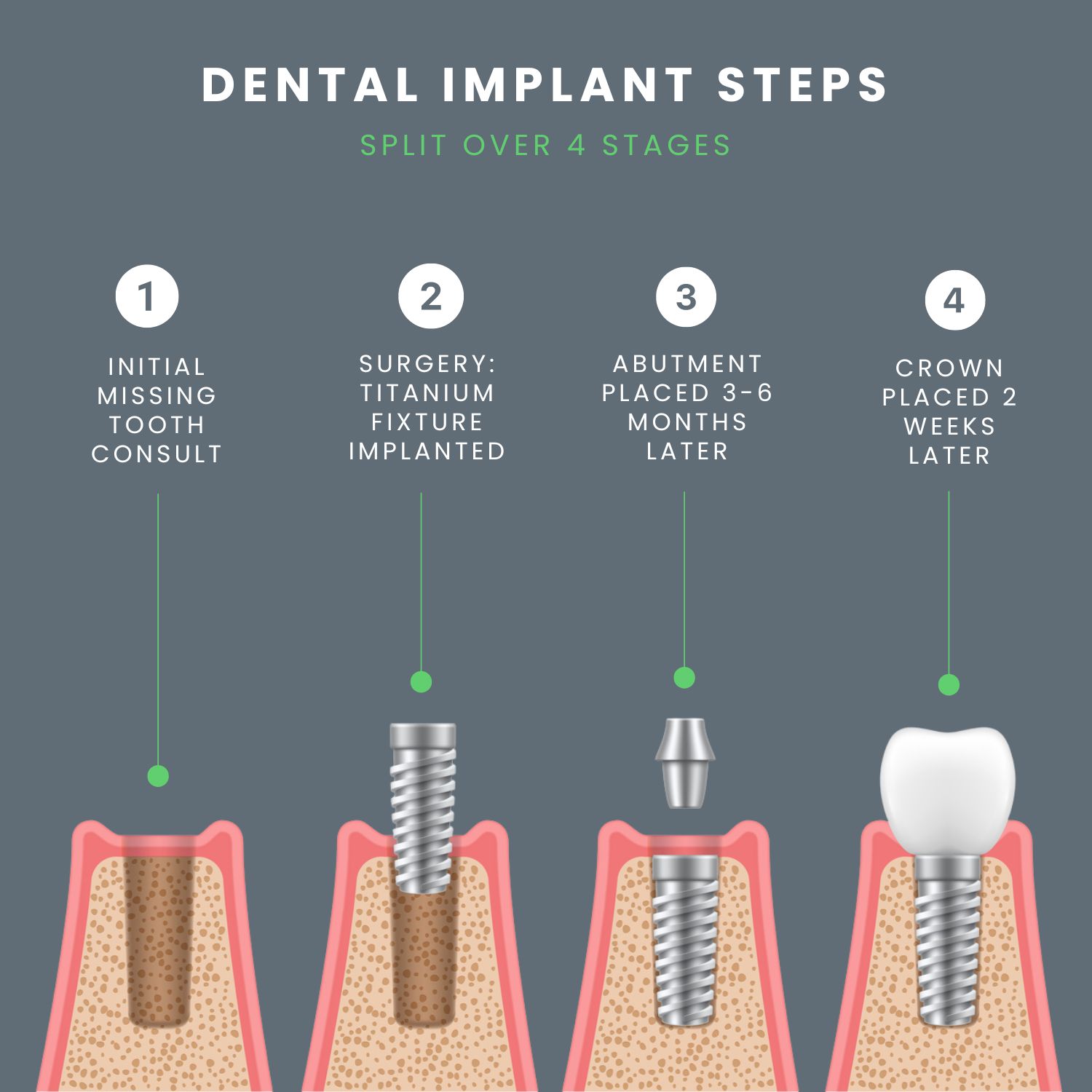 tooth implant process