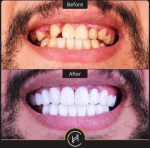 How long do I have to stay in Turkey for dental implants?