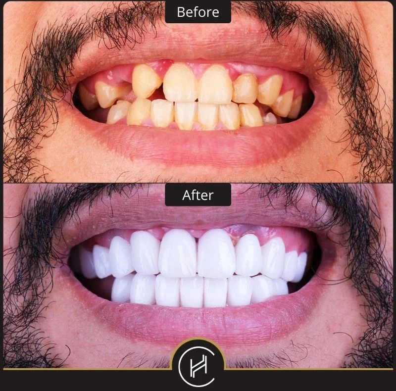 How long do I have to stay in Turkey for dental implants?