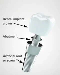 Why does my dental implant hurt when I chew?