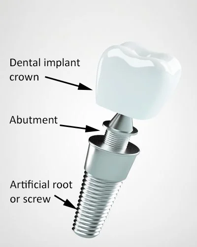 Why does my dental implant hurt when I chew?