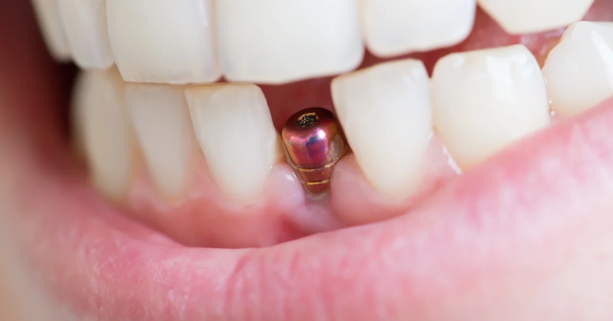 Are tooth implants painful?