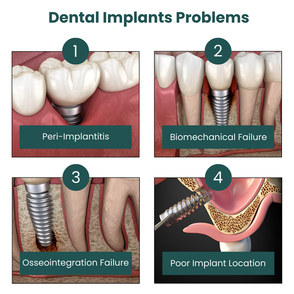 When are dental implants not recommended?