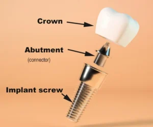 How do you get implants when you can't afford them?