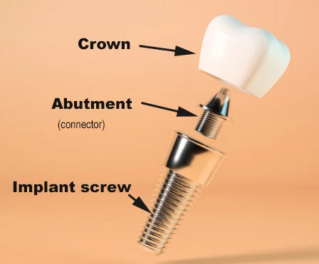 How do you get implants when you can't afford them?
