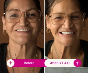 Can your body reject dental implants years later?