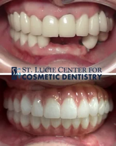 How long does it take to get a full set of teeth?