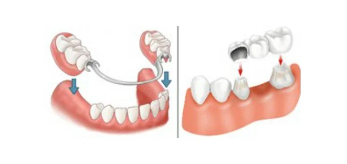 What is the cheapest option to replace missing teeth?