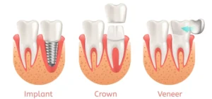 How much does a crown cost?