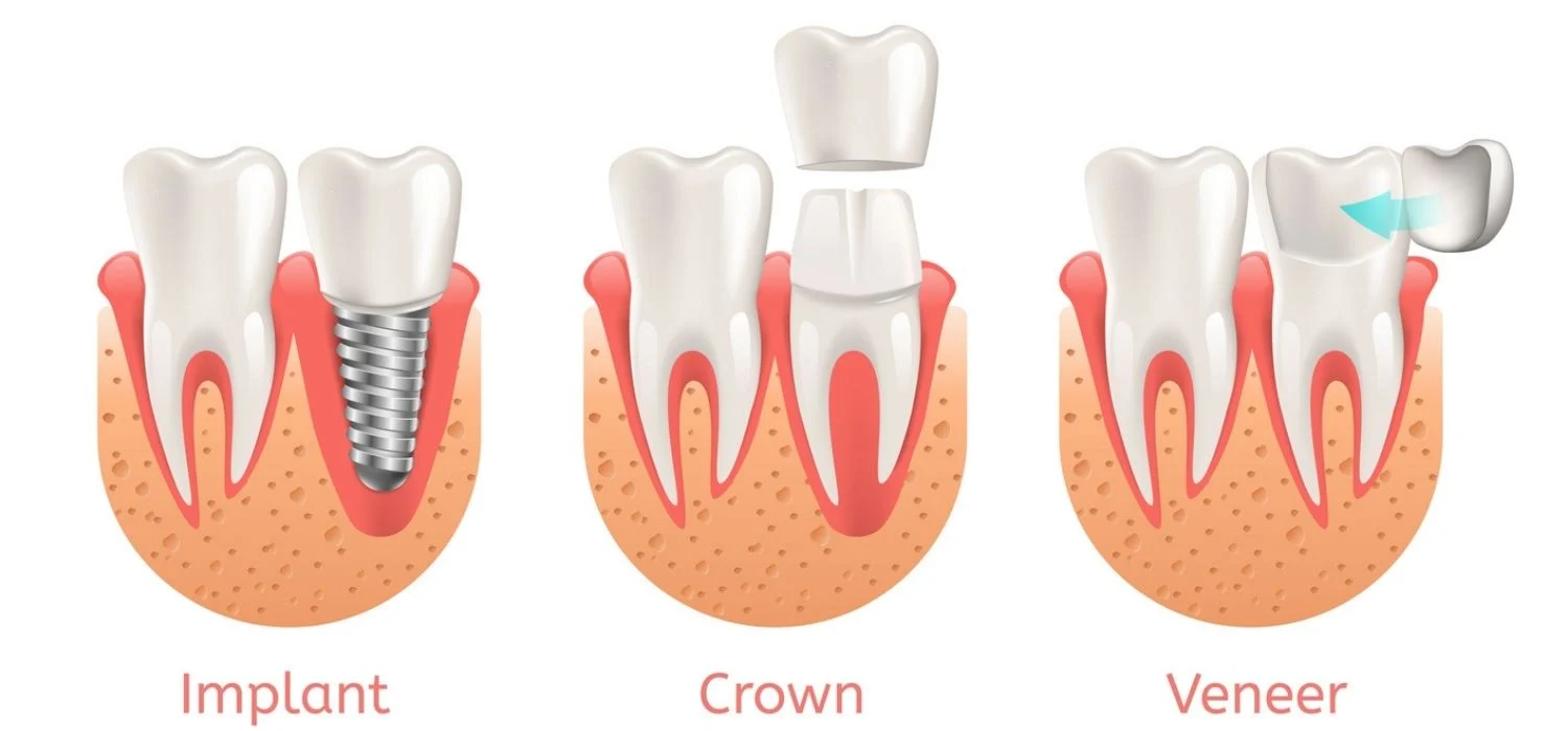 How much does a crown cost?