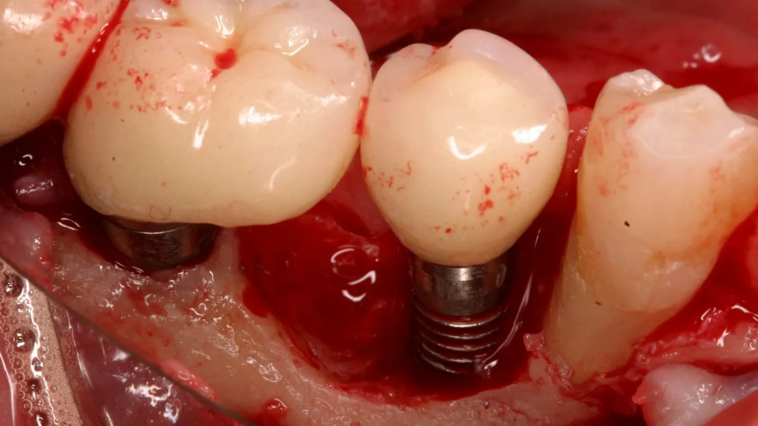 What does no one tell you about dental implants?