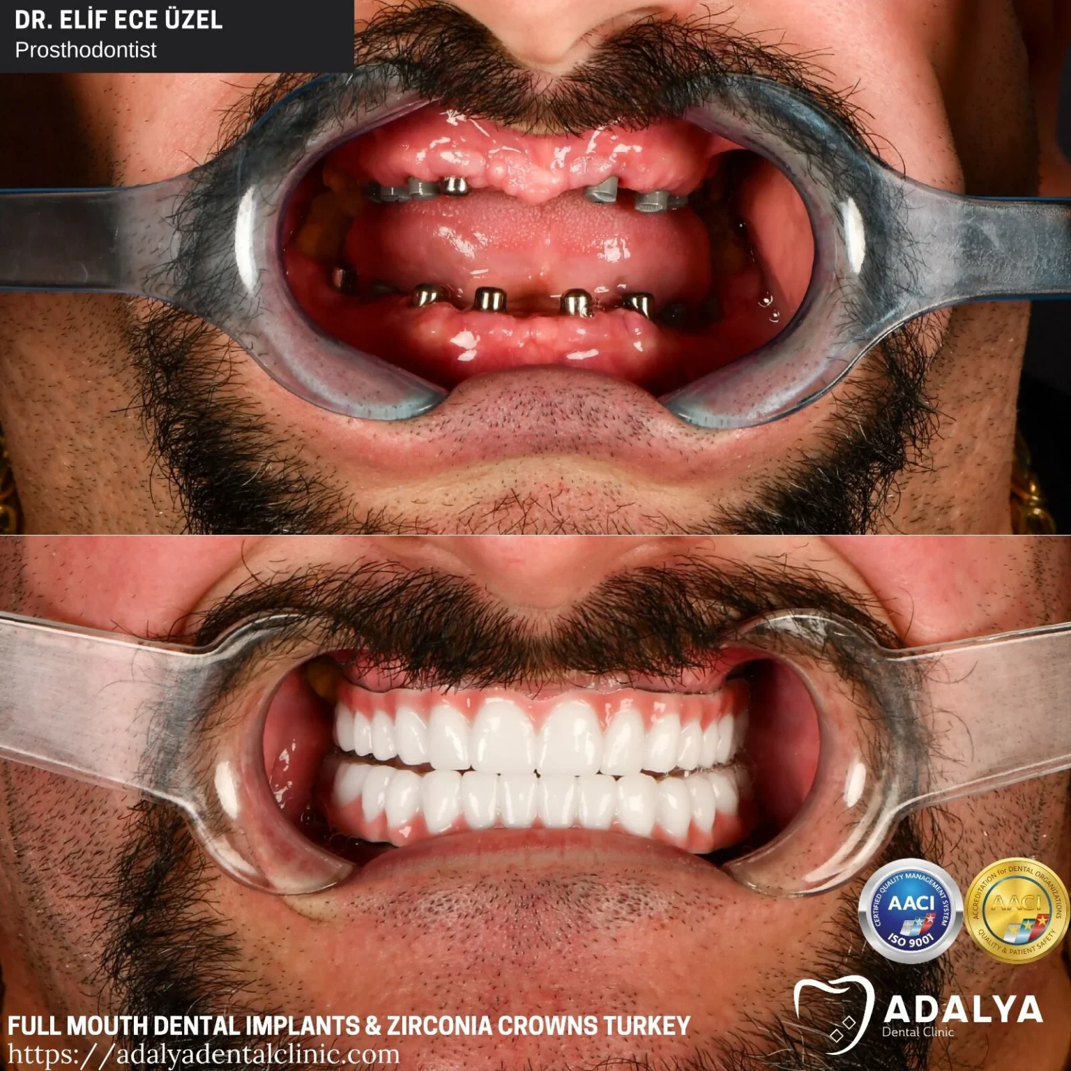 How much for teeth implants in Turkey?