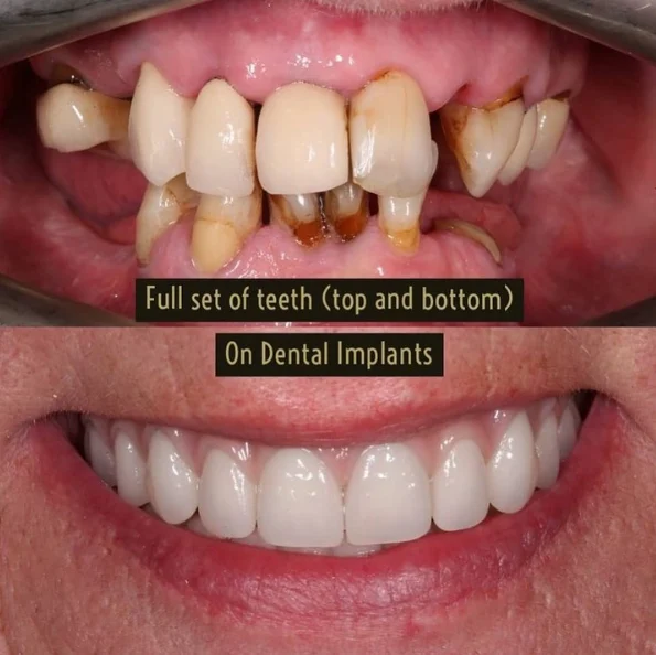 Can I get full mouth dental implants on NHS?