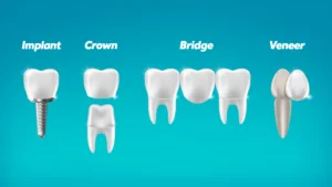 dental implants on nhs