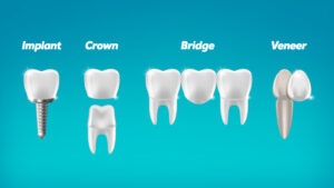 Do I qualify for dental implants on the NHS?