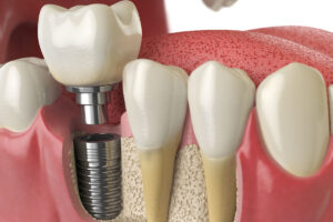 How long does a dental implant last in the UK?