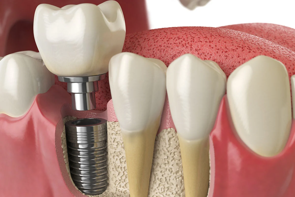 How long do dental implants last in the UK?