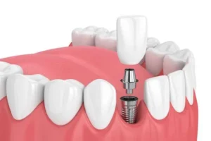 What is the most painful part of a dental implant?