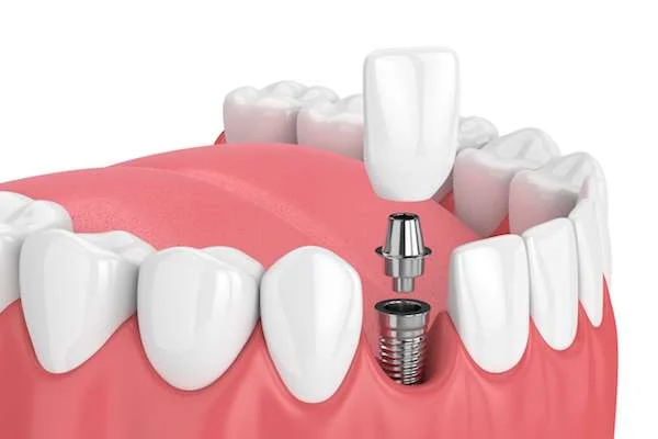 What is the most painful part of a dental implant?
