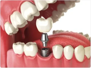 tooth replacement cost