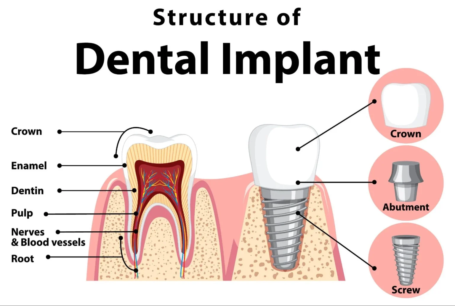 How long do teeth implants last?