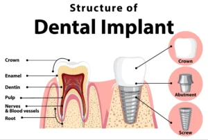 How long do teeth implants last?