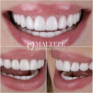 How much is it to get a perfect set of teeth?