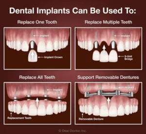 How many teeth do you need for implants?