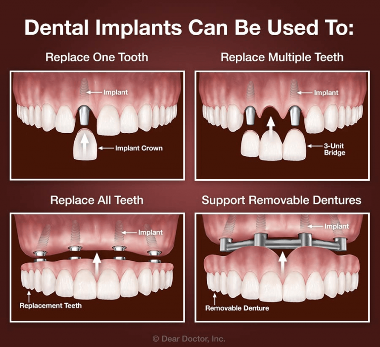 How many teeth can one implant replace?