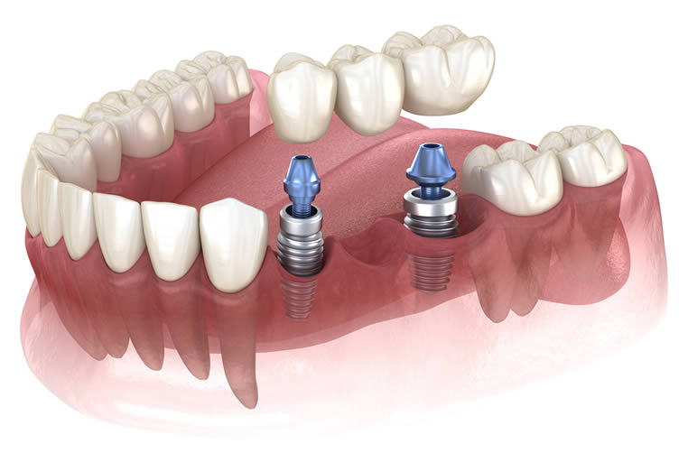 dental implant uk
