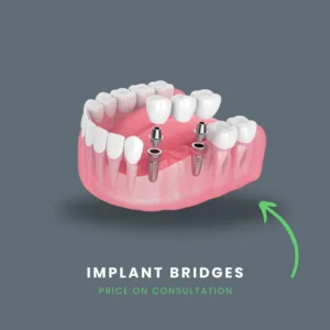How many implants do you need for 3 missing teeth?