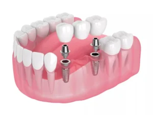 How many teeth can be on an implant bridge?