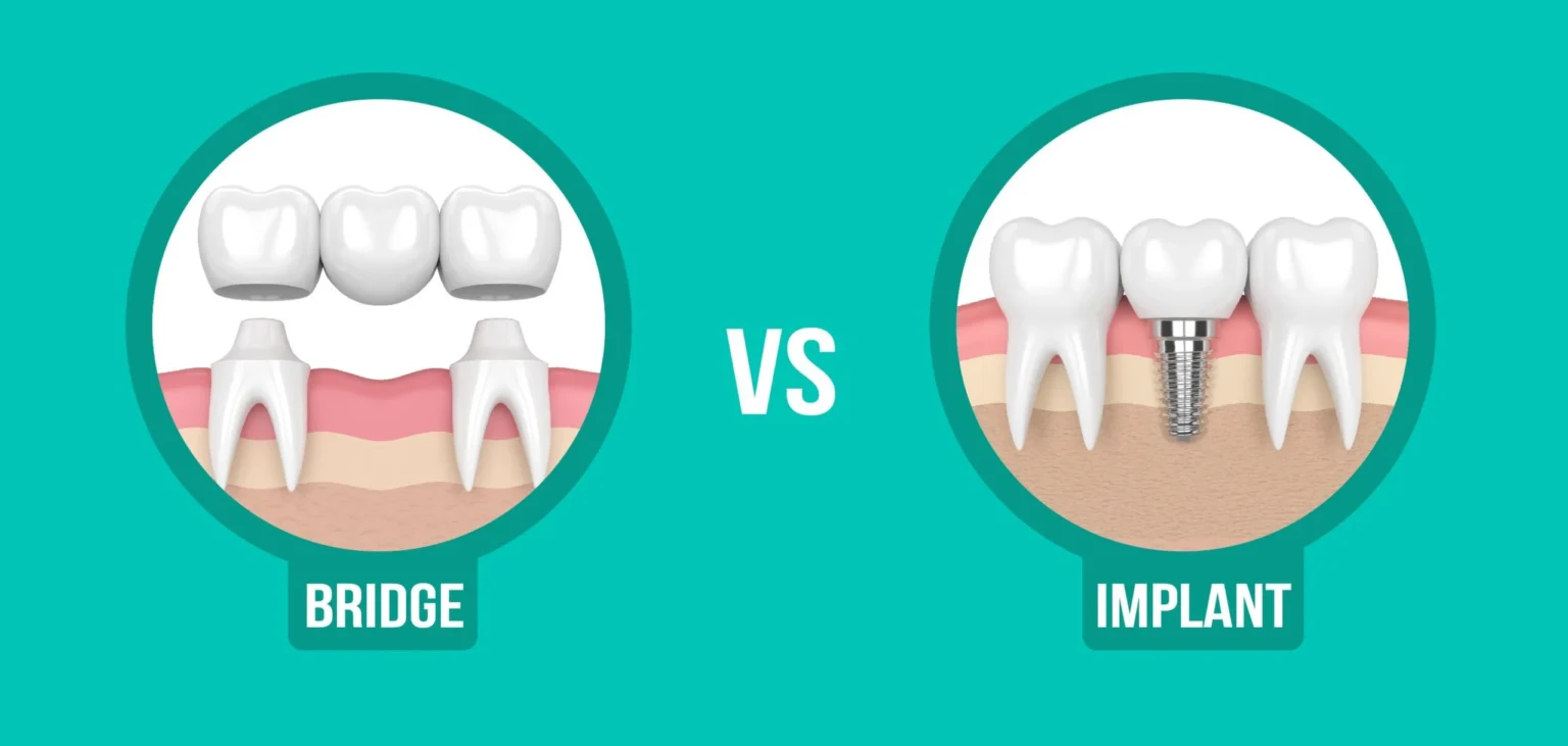 Is bridging better than implant?