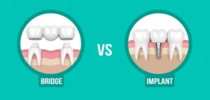 Is bridging better than implant?