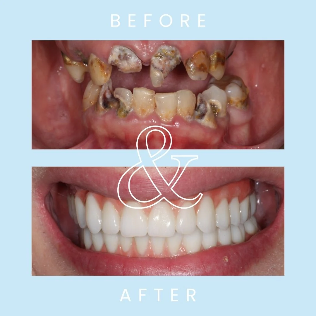 How can I fix my teeth with no money in the UK?